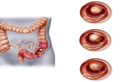 نقلة نوعية في تشخيص سرطان القولون باختبار دم بدقة 95%